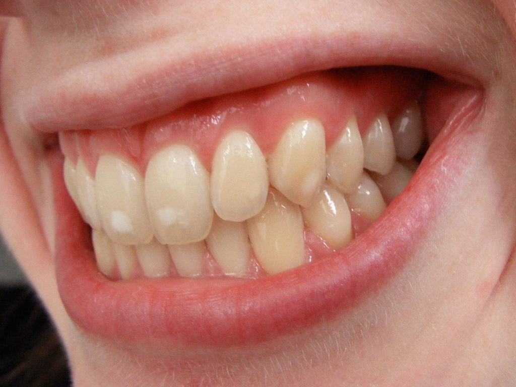 Essential Tips On How To Whiten Yellow Teeth