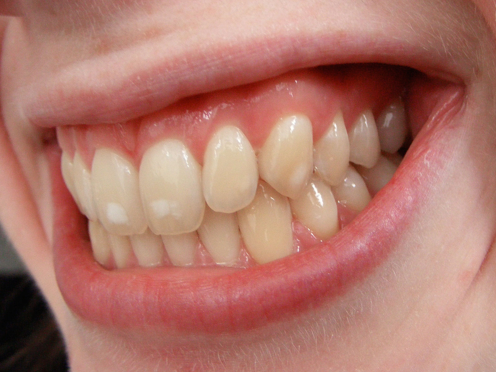 Teeth Whitening Best Rancho Cucamonga Dentists