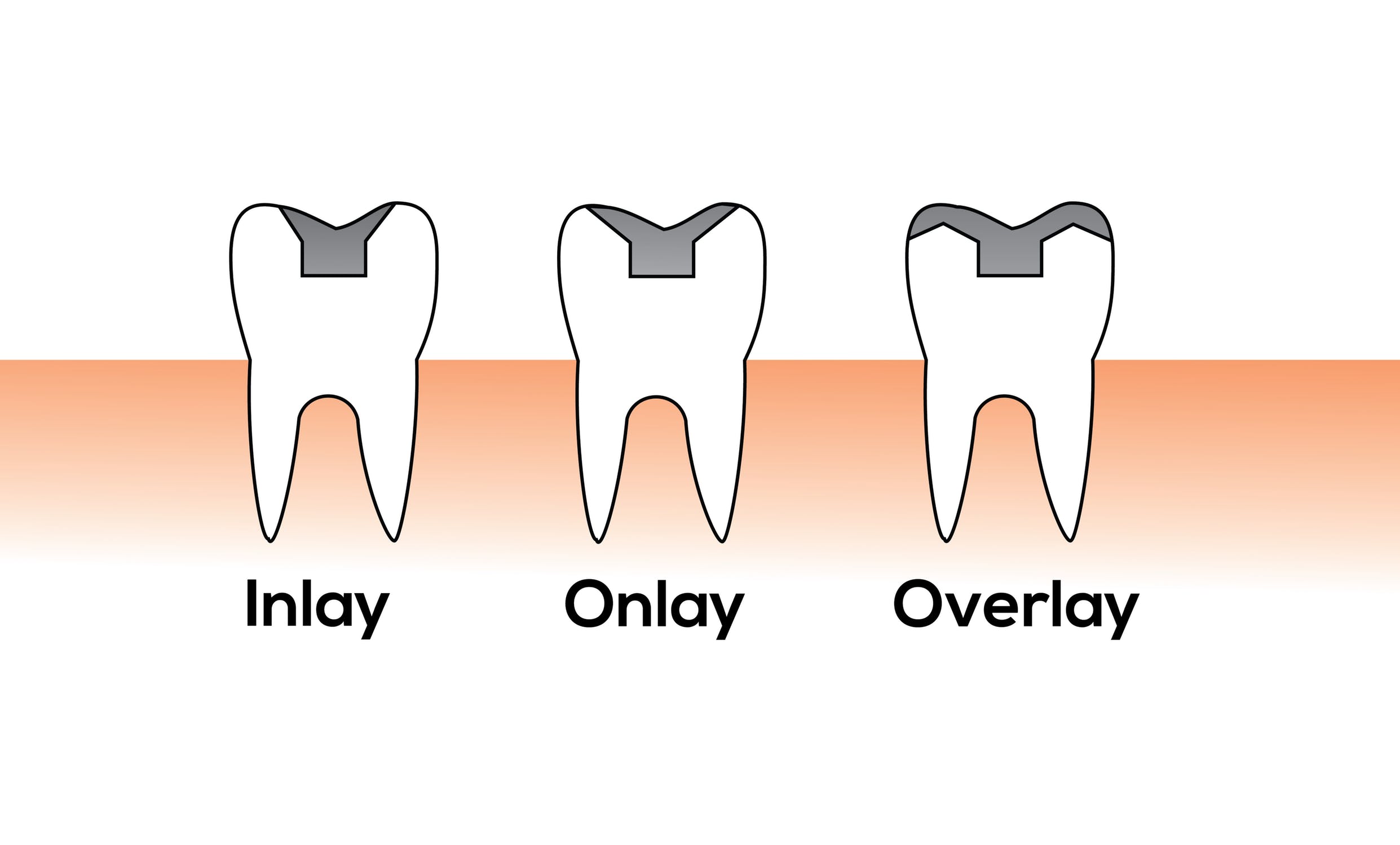 Dental Crowns | Inlay Outlay Best Rancho Cucamonga Dentist
