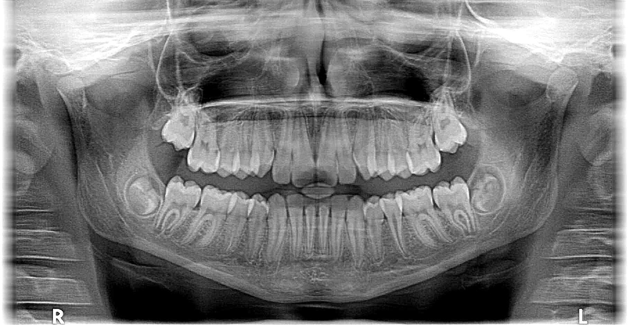teeth xrays children dentist in rancho cucamoong ca