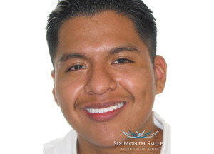 Clear Braces | Aesthetic Fillings | Dentist In Rancho Cucamonga | Rancho Cucamonga Dentist