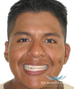 CLear Braces | Rancho Cucamonga Dentists | Best Dentist Rancho Cucamonga
