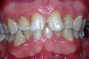 Aesthetic Fillings | Dentist In Rancho Cucamonga | Rancho Cucamonga Dentist