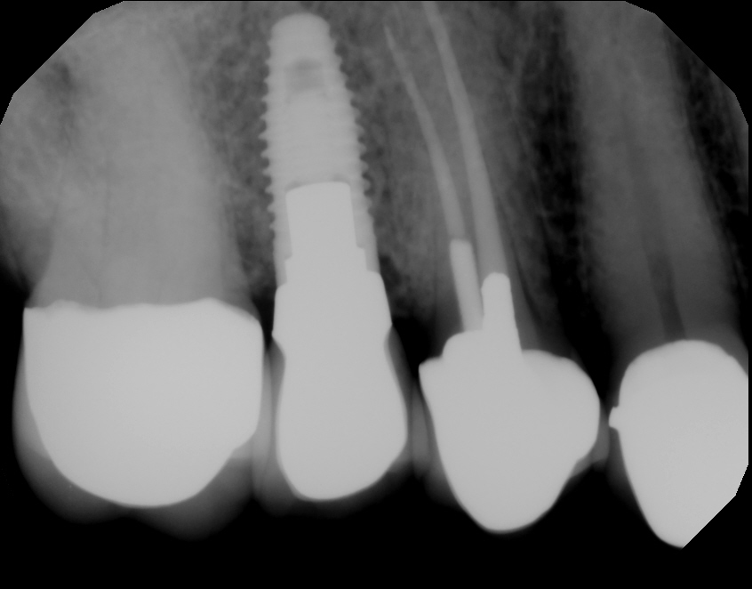 Dental Implants | Dentist In Rancho Cucamonga | Rancho Cucamonga Dentist