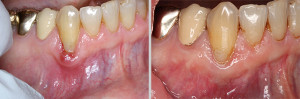 Gum Disease Treatment | Dentist In Rancho Cucamonga | Rancho Cucamonga Dentist