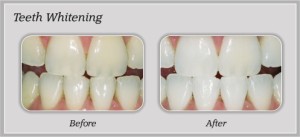 Teeth Whitening | Dentist In Rancho Cucamonga | Rancho Cucamonga Dentist