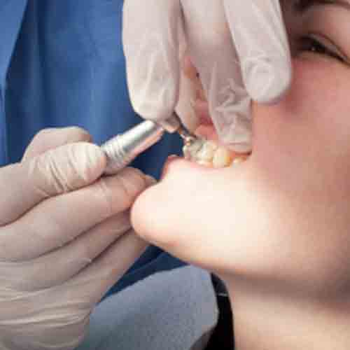 Dental Implants Rancho Cucamonga | Dental Implant Service Rancho Cucamonga