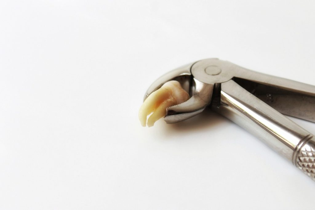 Wisdom Teeth Rancho Cucamonga Dentist