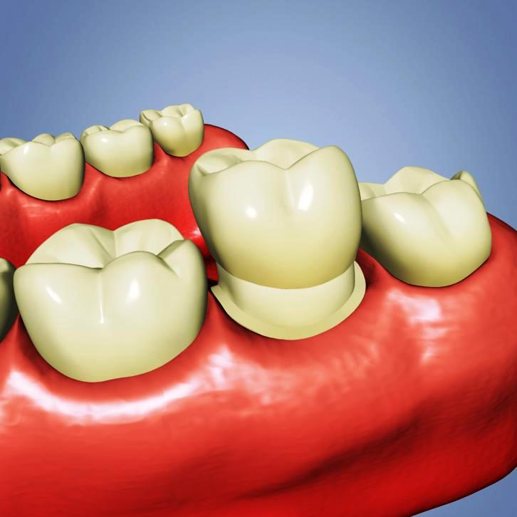 Dental Crowns Best Local Rancho Cucamonga Dentist