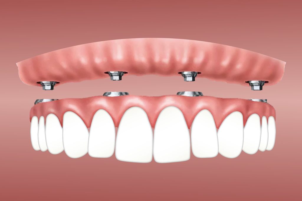 Dental Implants Best Dentist In Rancho Cucamonga Rancho Cucamonga Dentist