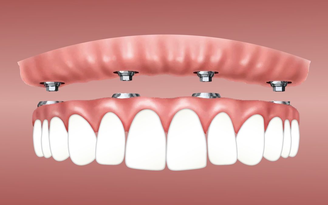 Getting A Better Understanding Of Dental Implants