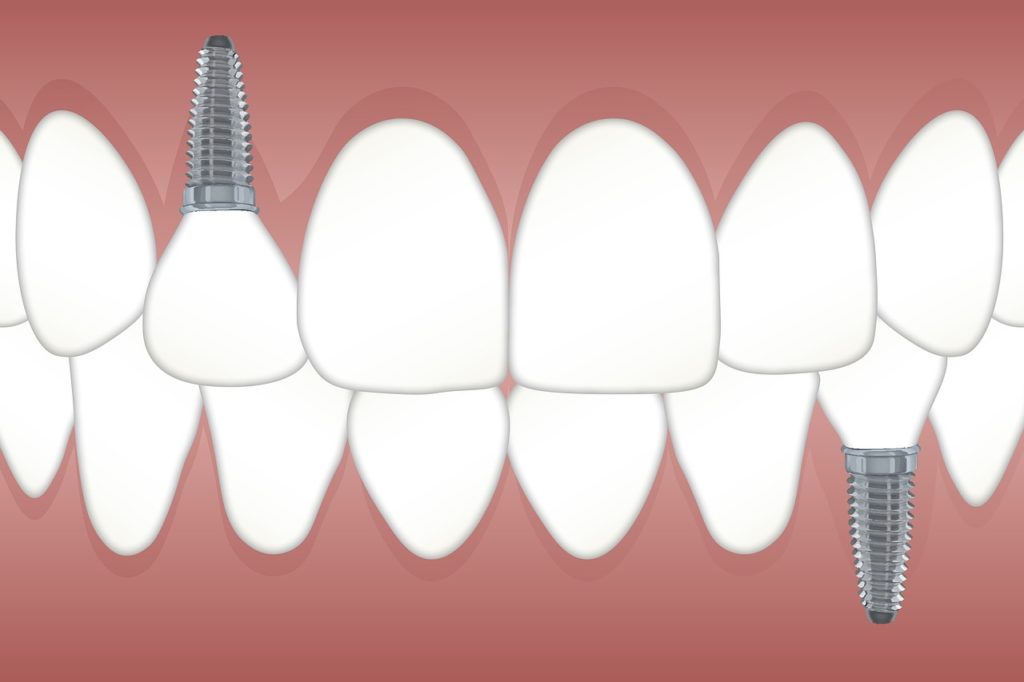 Dental Implants Best Rancho Cucamonga Dentist Dentist In Rancho Cucamonga