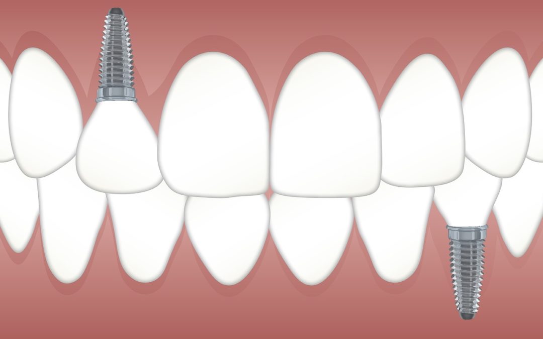 Learn About Single Tooth Dental Implants
