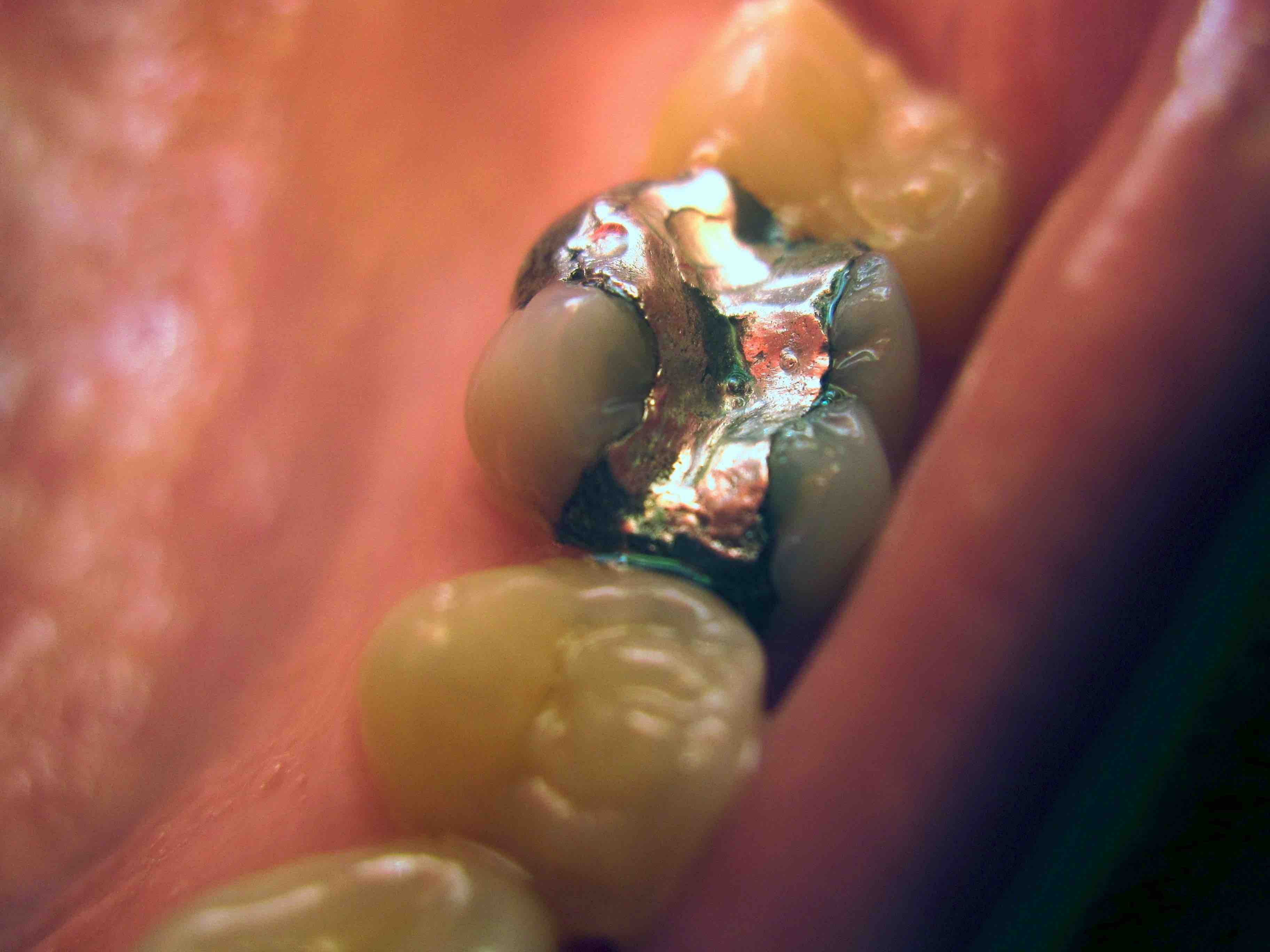 Filling Dentist In Rancho Cucamonga