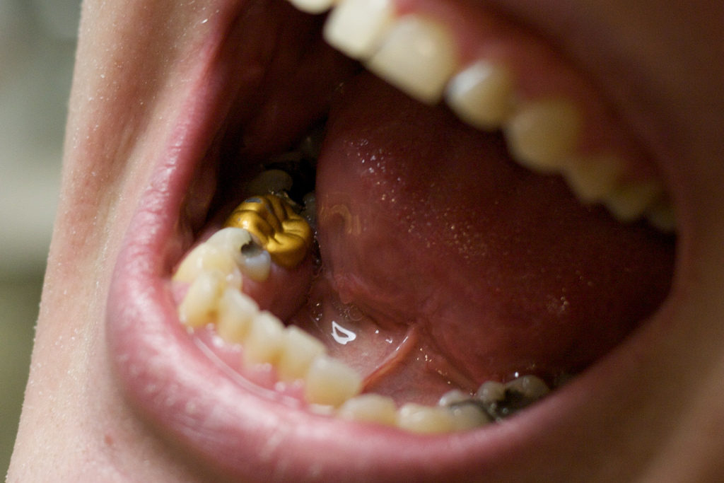 Tooth Filling Best Rancho Cucamonga Dentist