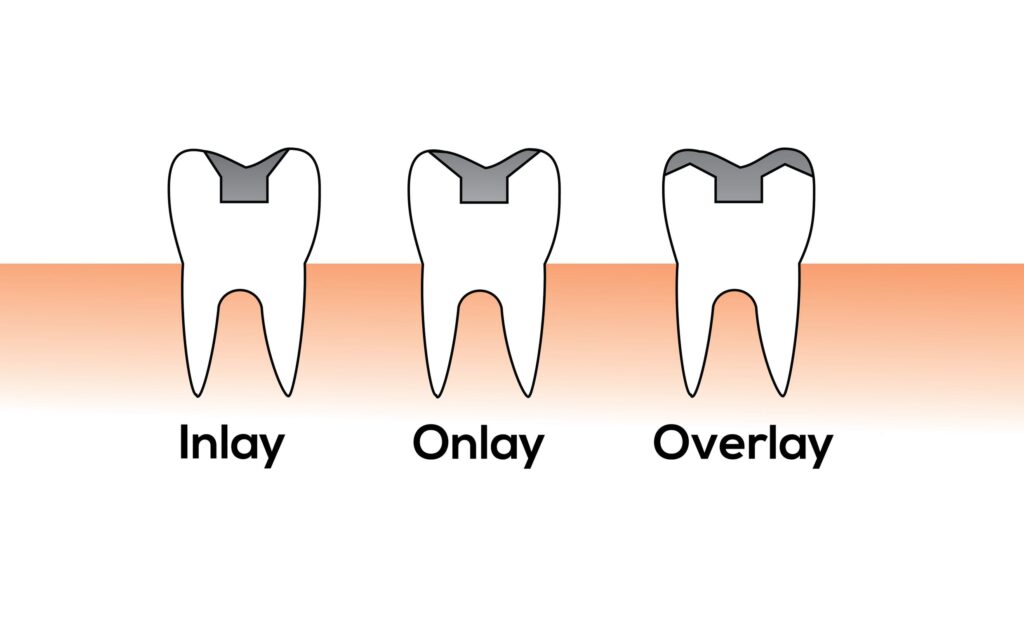Dental-Crowns-Inlay-Outlay-Best-Rancho-Cucamonga-Dentist